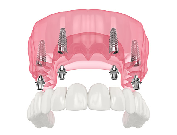 All on 4 Dental Implants